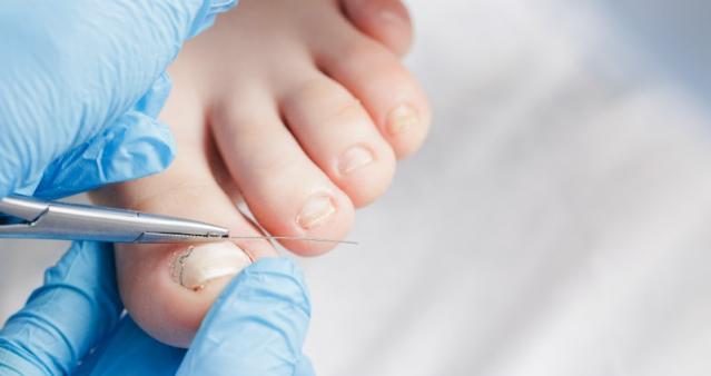 soigner un ongle incarné soigner un ongle incarné