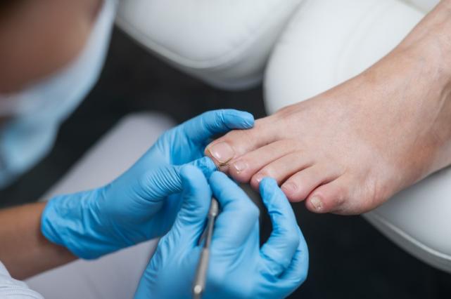 mycose ongle traitement