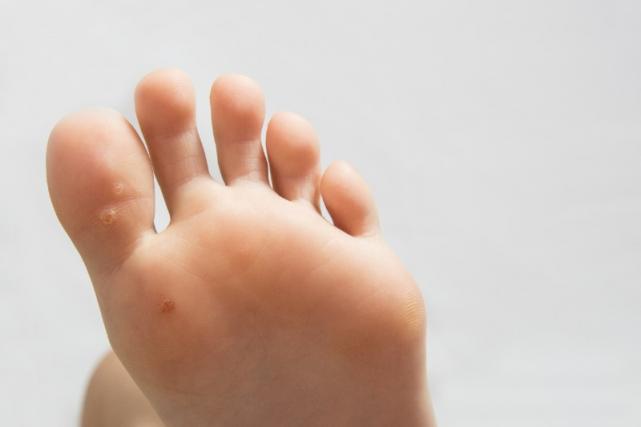 traitement verrue plantaire Ransart